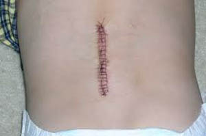 After Back Surgery